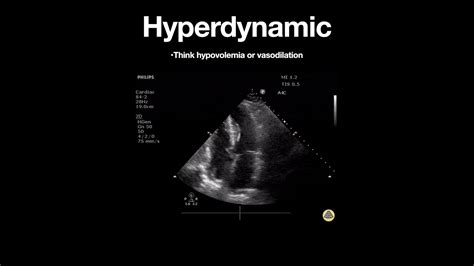 left ventricular systolic function is hyperdynamic|what causes hyperdynamic left ventricle.